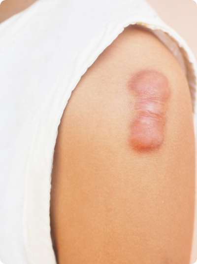 Keloid scar on the upper arm