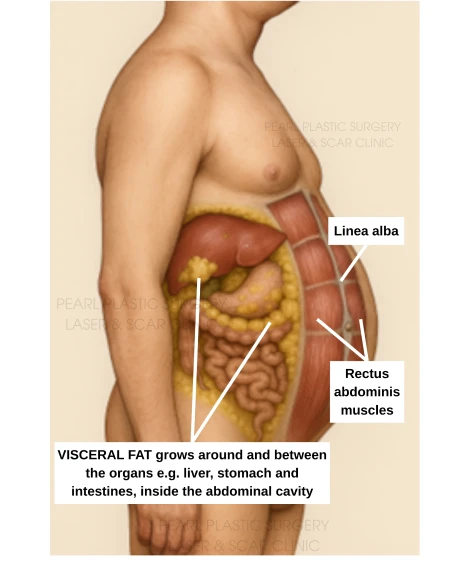 Central Obesity/Visceral Fat