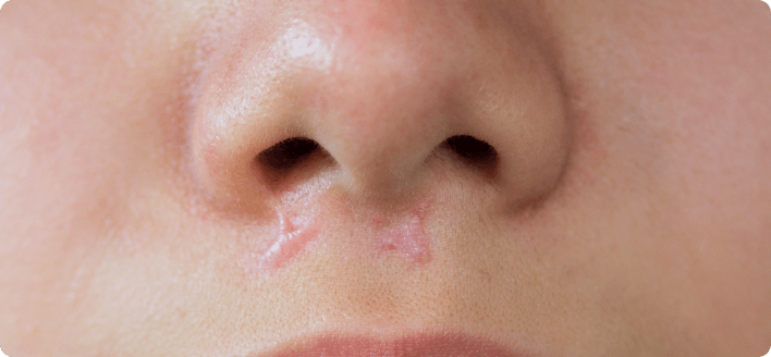 Scar on the philtrum