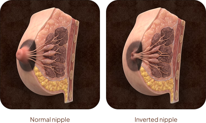 inverted nipple correction treatment in Singapore.