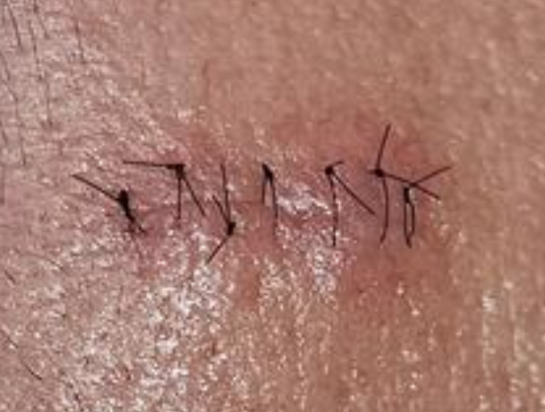 Scar revision surgery Singapore