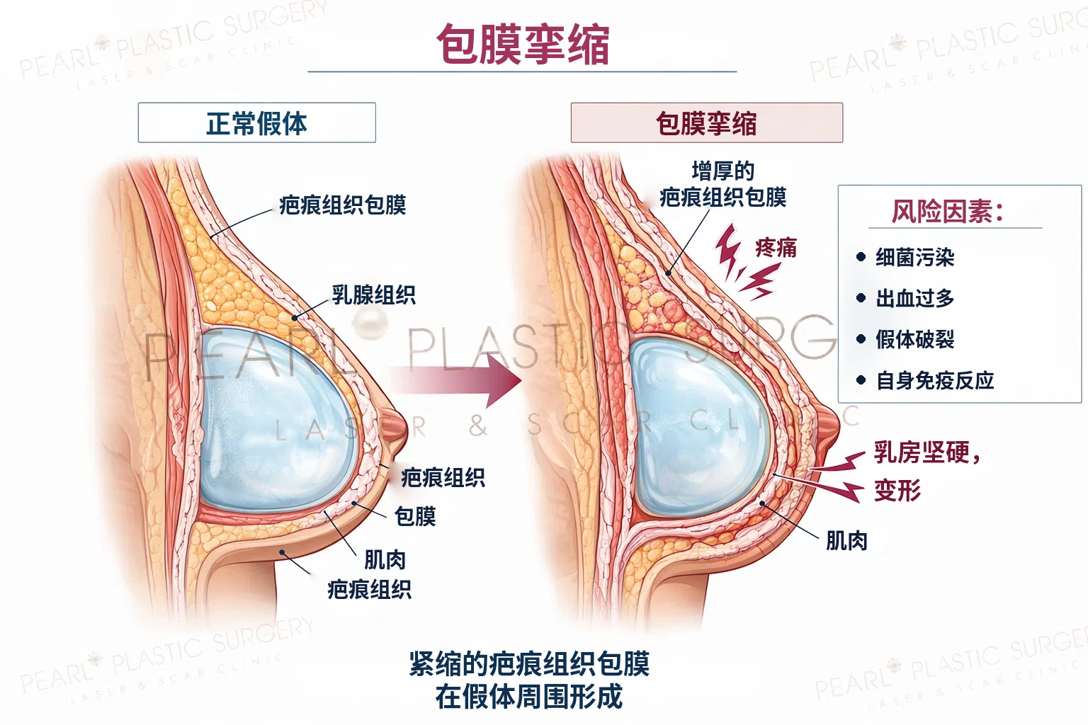 包膜挛缩：正常假体与包膜挛缩对比