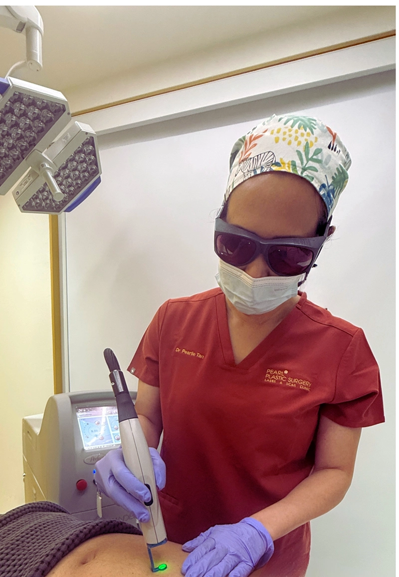 Alat laser Vbeam ditempelkan pada keloid pasien