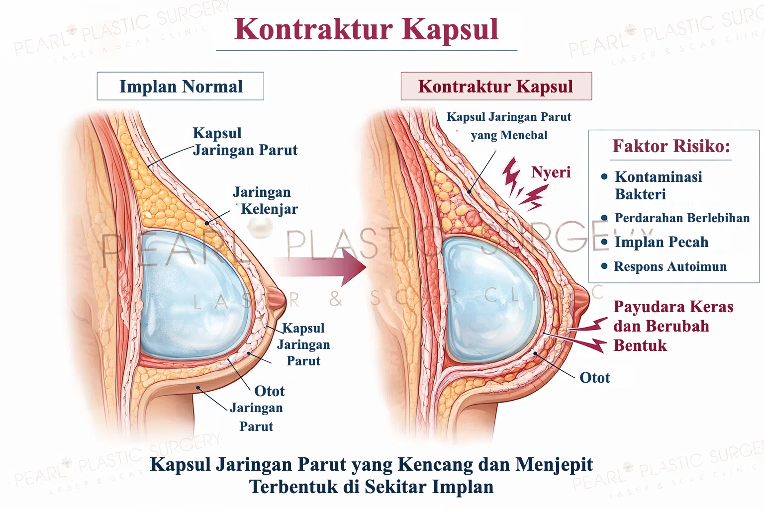 Kontraktur kapsul: implan normal dibandingkan kapsul jaringan parut yang menebal di sekitar implan