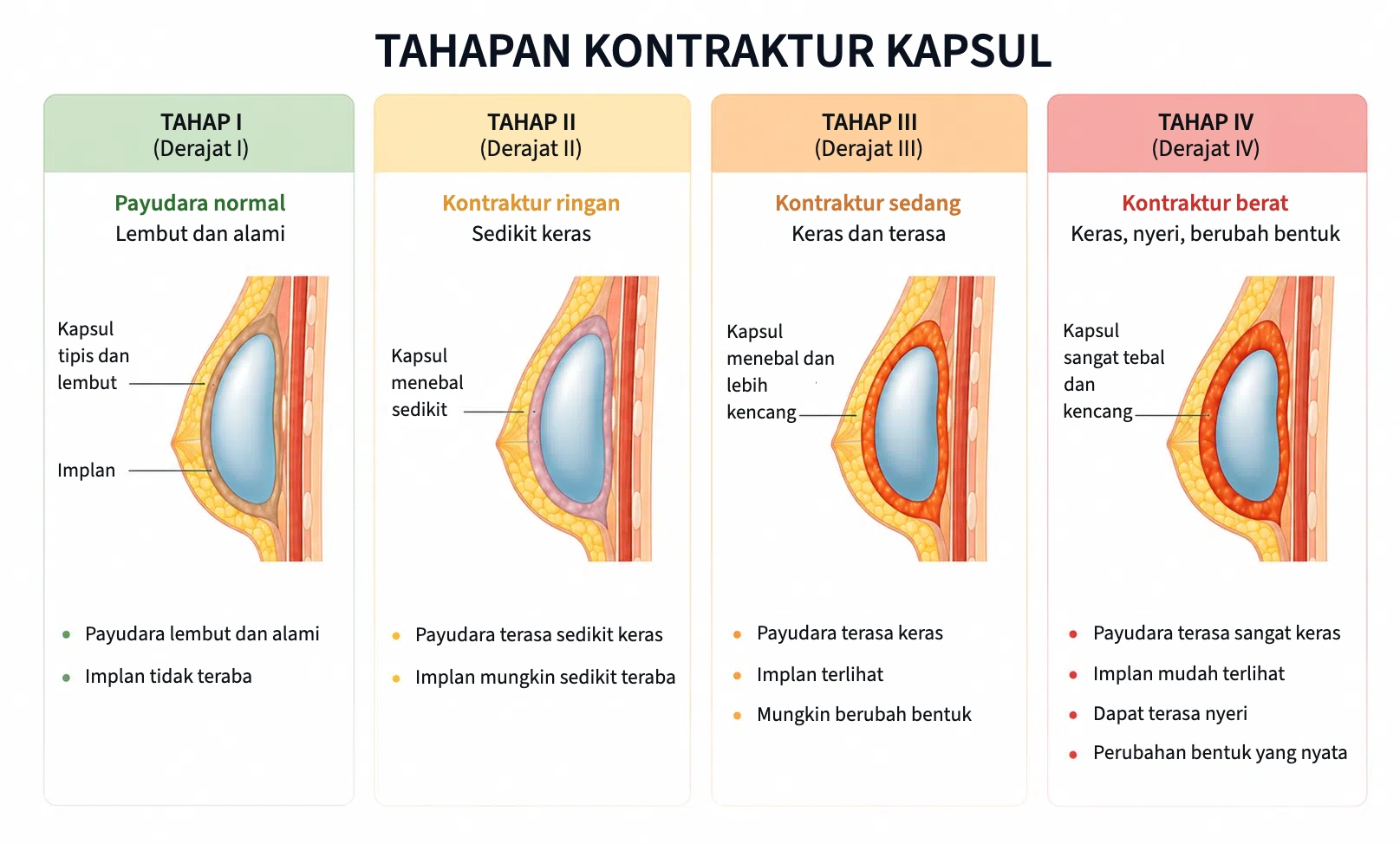 Tahapan kontraktur kapsul: tahap I sampai IV (derajat I sampai IV)