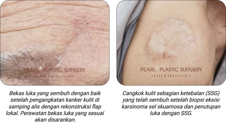 Bekas luka setelah pengangkatan kanker kulit dengan rekonstruksi flap lokal dan cangkok kulit sebagian ketebalan (SSG)