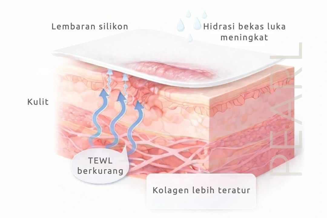 Lembaran silikon pada bekas luka: hidrasi bekas luka meningkat, TEWL berkurang, dan kolagen lebih teratur