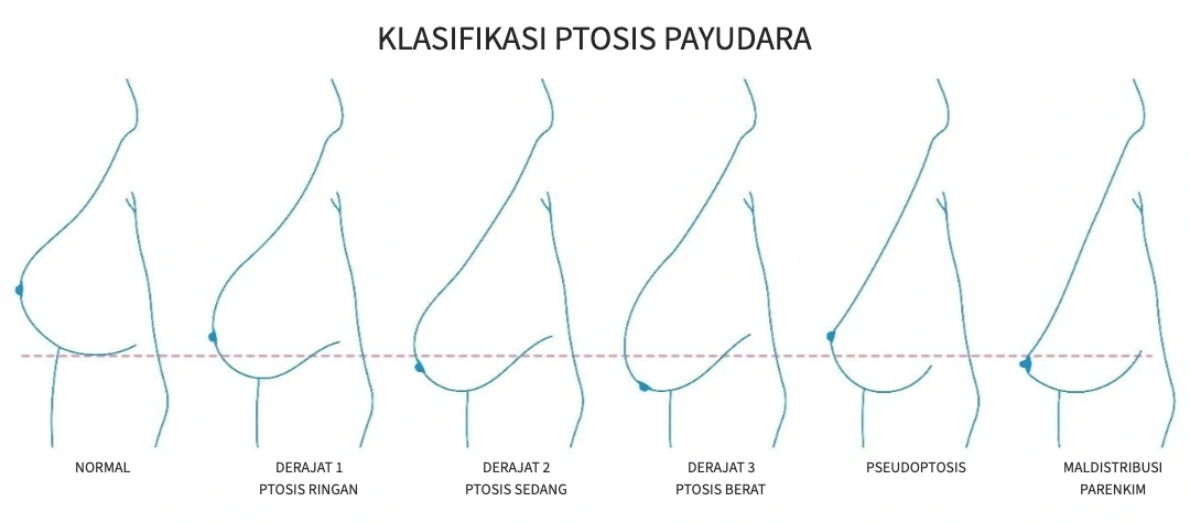 Klasifikasi ptosis payudara: normal, derajat 1, 2, 3, pseudoptosis, dan maldistribusi parenkim