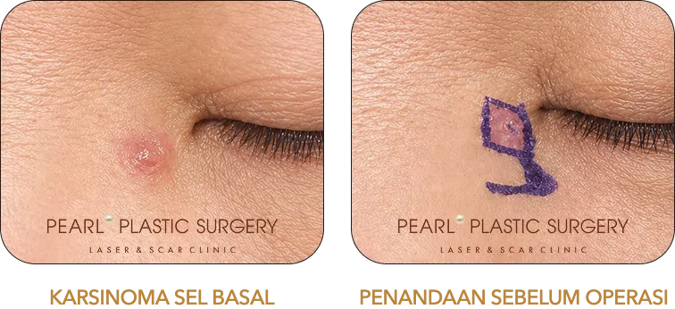 Karsinoma sel basal dan penandaan sebelum operasi