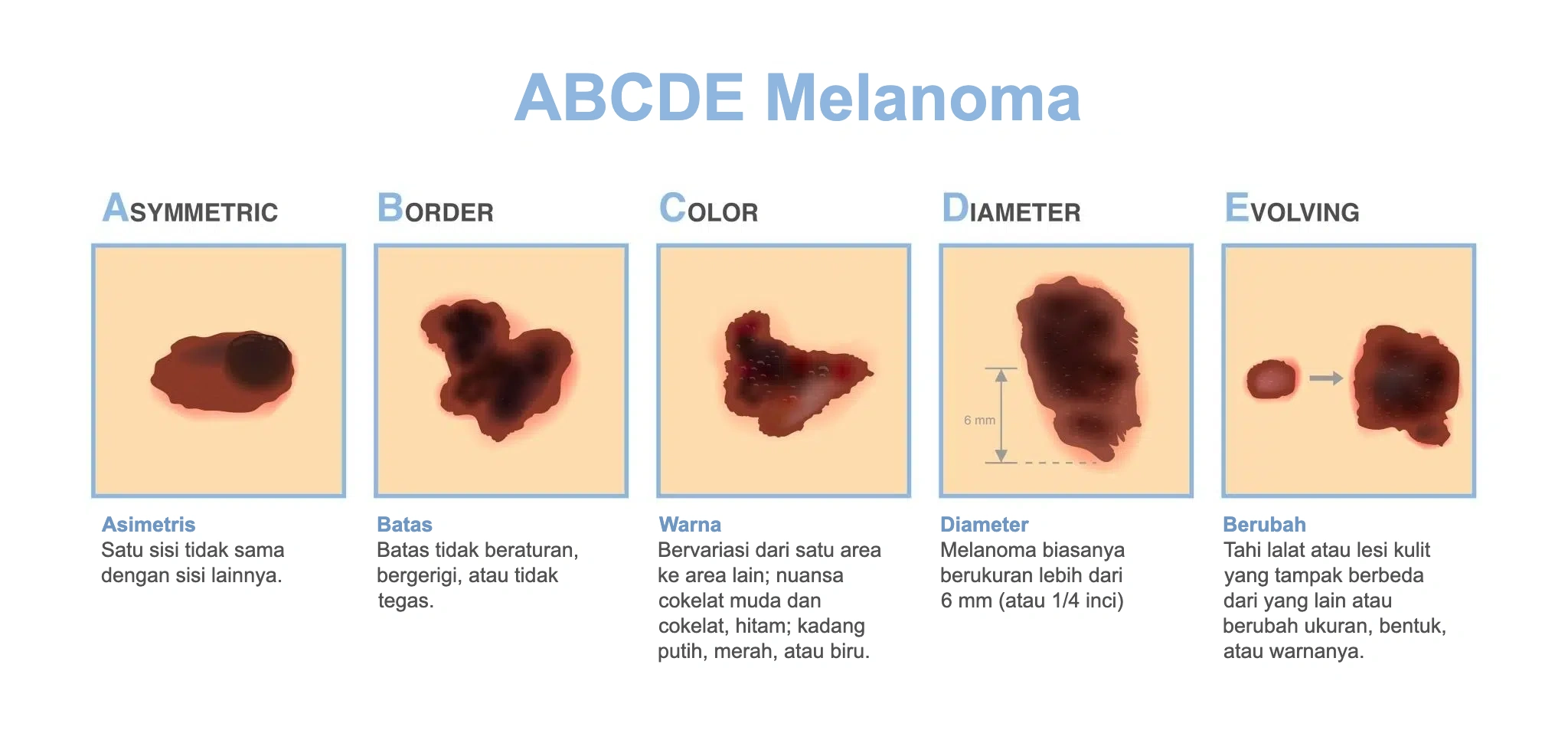 ABCDE melanoma: asimetris, batas, warna, diameter, dan berubah