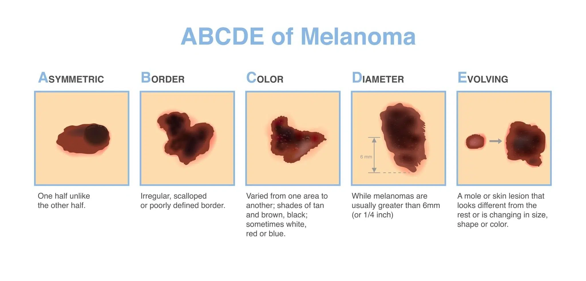 ABCDE of melanoma: asymmetry, border, colour, diameter and evolving