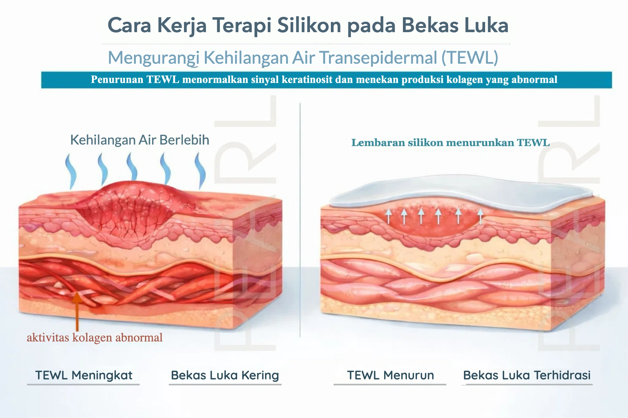 Cara kerja terapi silikon pada bekas luka: mengurangi kehilangan air transepidermal (TEWL)