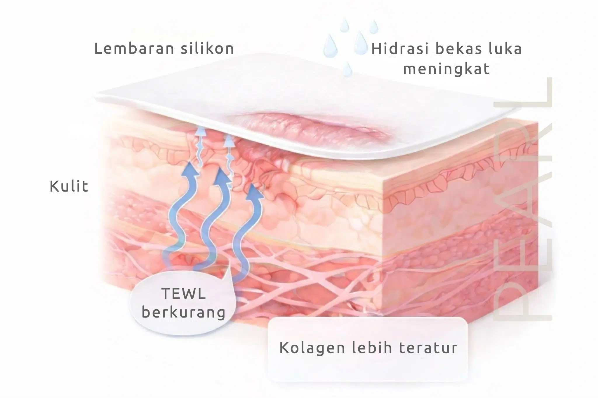 Lembaran silikon pada bekas luka: hidrasi bekas luka meningkat, TEWL berkurang, dan kolagen lebih teratur