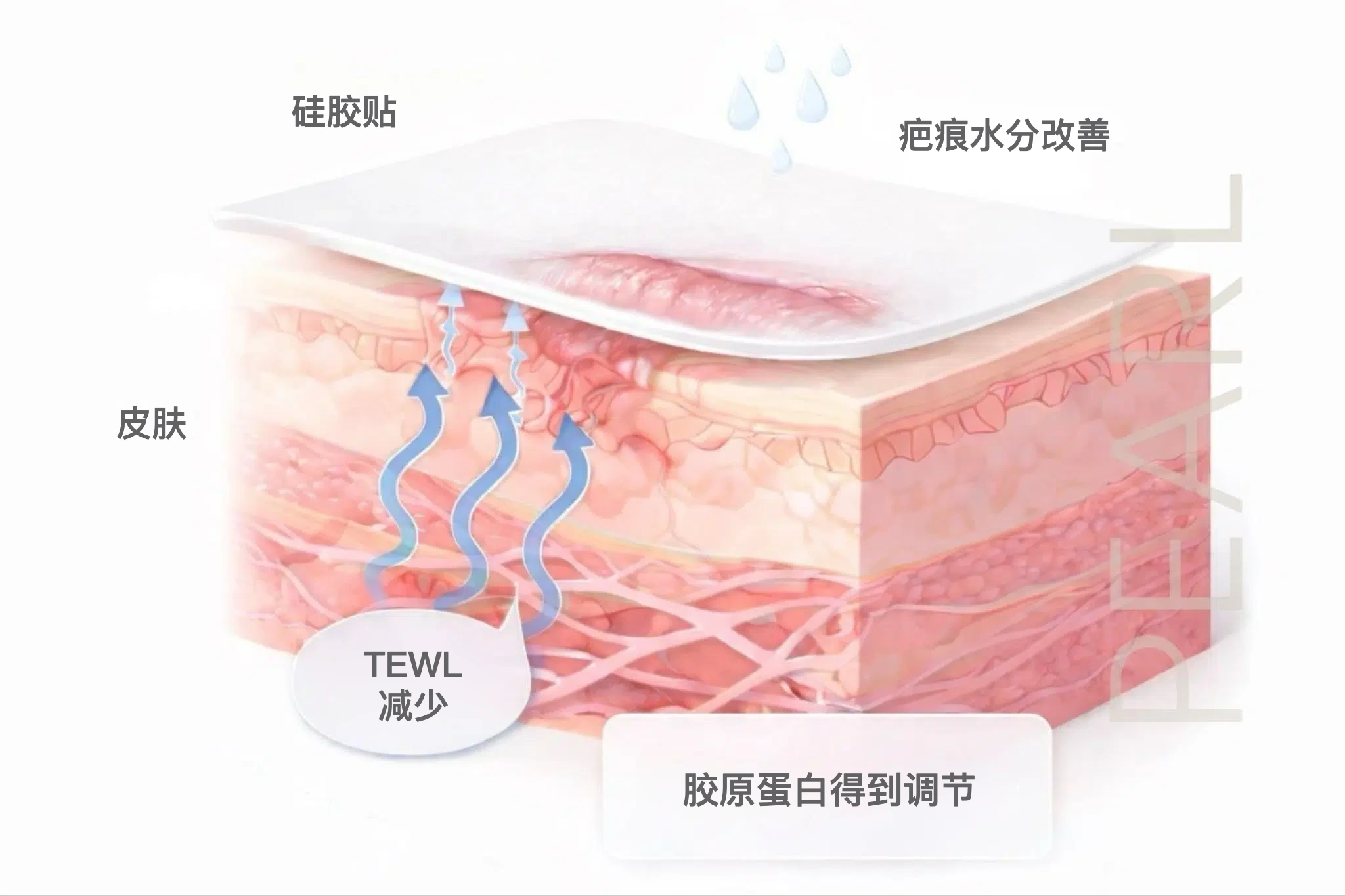 硅胶贴减少 TEWL，改善疤痕水分