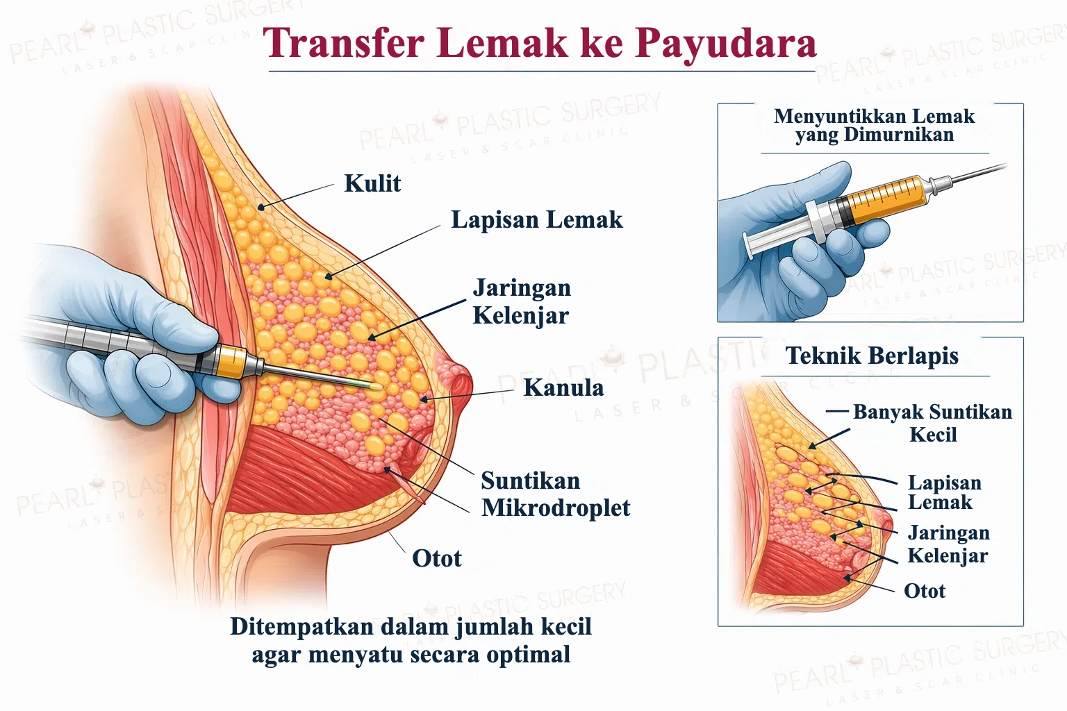 Transfer lemak ke payudara: menyuntikkan lemak yang dimurnikan dengan teknik berlapis