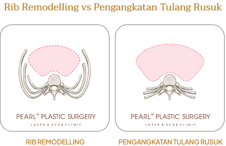 Perbandingan rib remodelling dan pengangkatan tulang rusuk