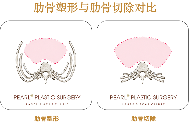 肋骨塑形与肋骨切除对比