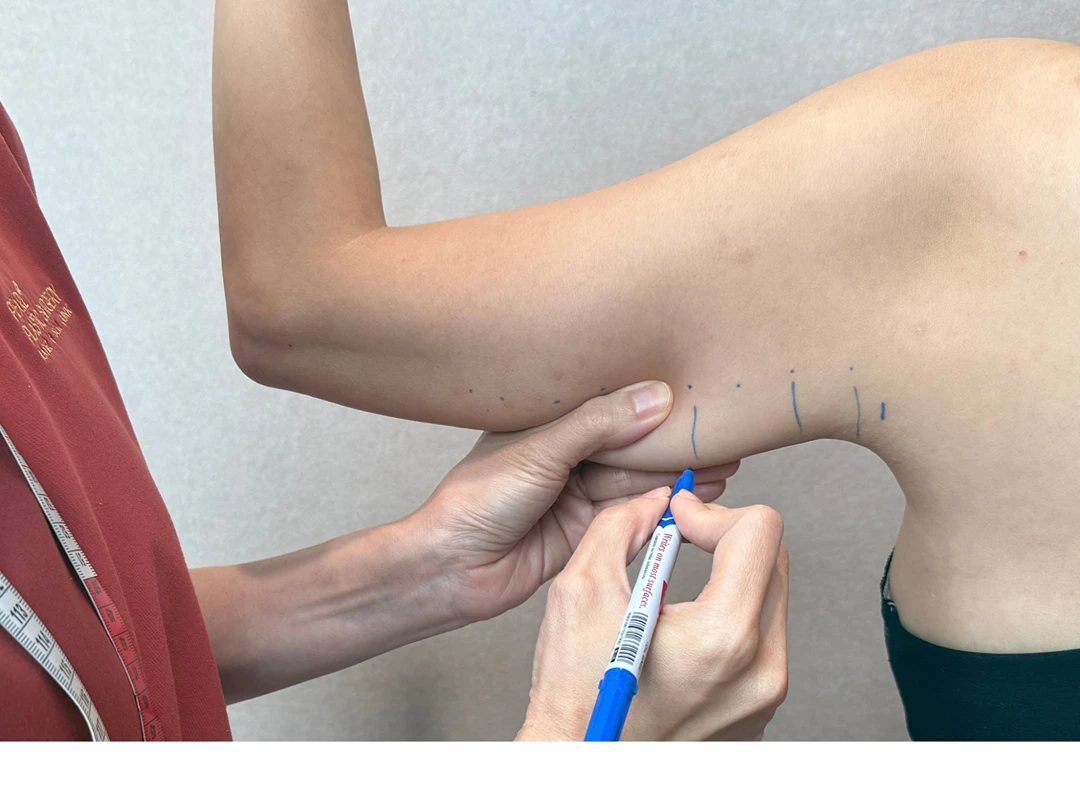 Dr Pearlie Tan marking the inner upper arm before brachioplasty surgery.