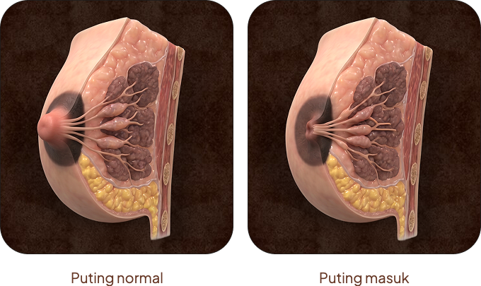 Puting normal dan puting masuk (inverted nipple)