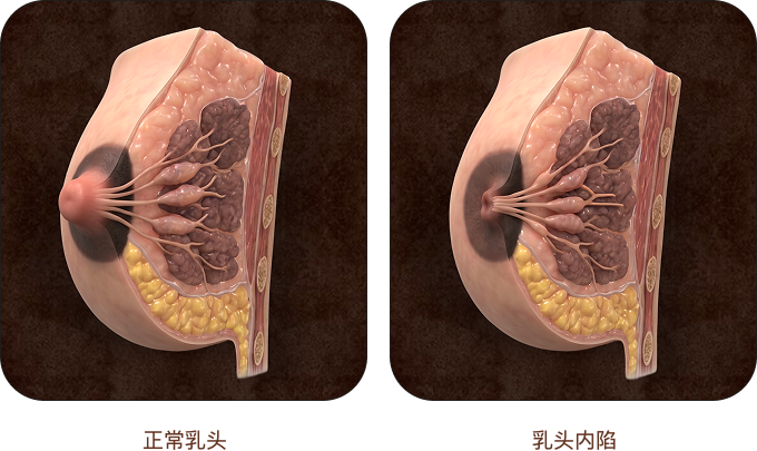正常乳头与乳头内陷对比