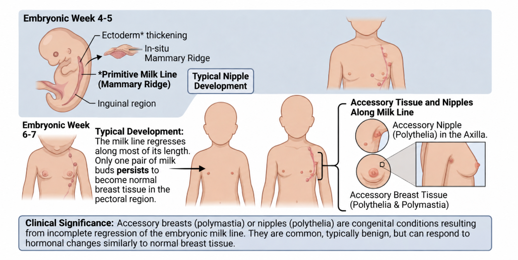 Medical illustration showing how embryonic milk lines develop and normally regress, with examples of persistent accessory breast tissue and supernumerary nipples along the chest and underarm.