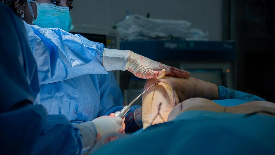 arm lift versus arm liposuction Singapore.