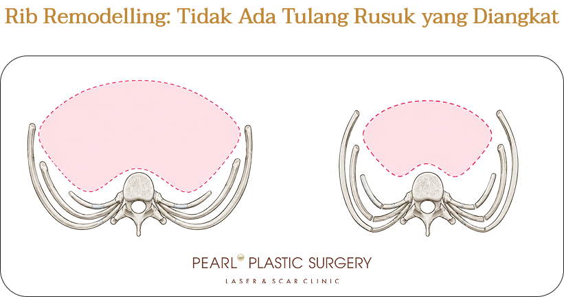 Rib remodelling: tidak ada tulang rusuk yang diangkat, ilustrasi tulang rusuk sebelum dan sesudah