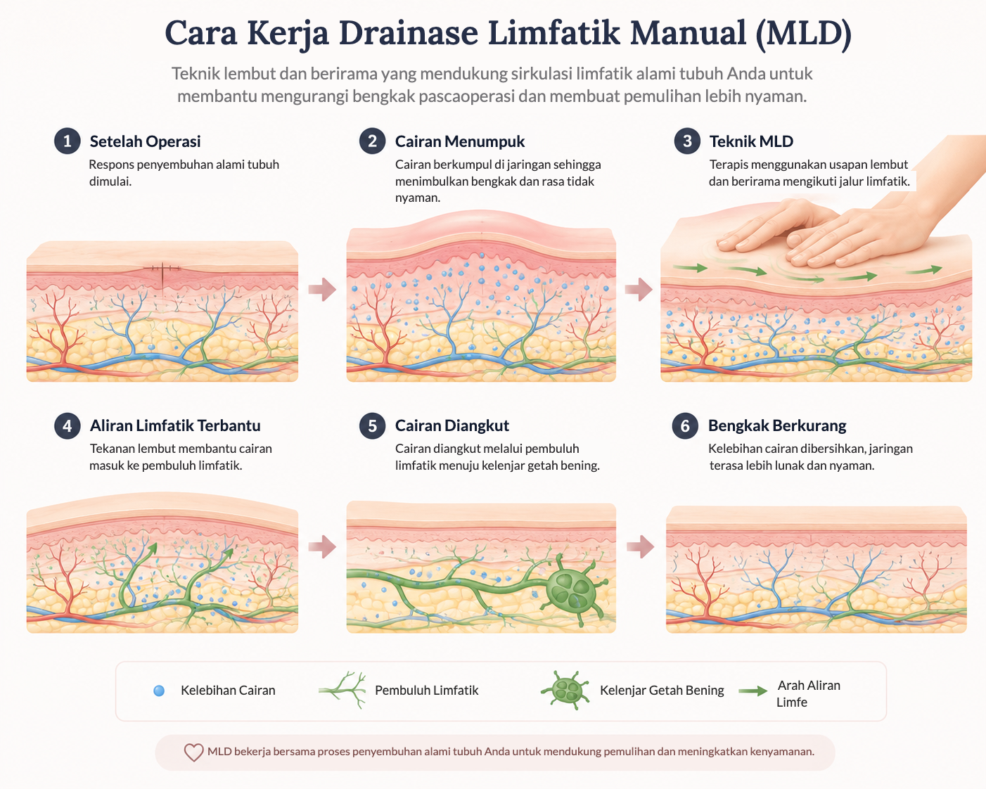 Cara kerja drainase limfatik manual (MLD) dalam enam tahap