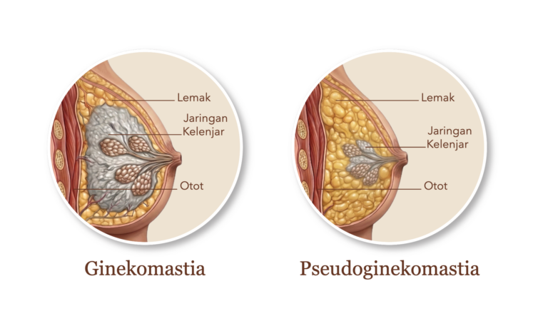 Perbandingan ginekomastia dan pseudoginekomastia: lemak, jaringan kelenjar, dan otot