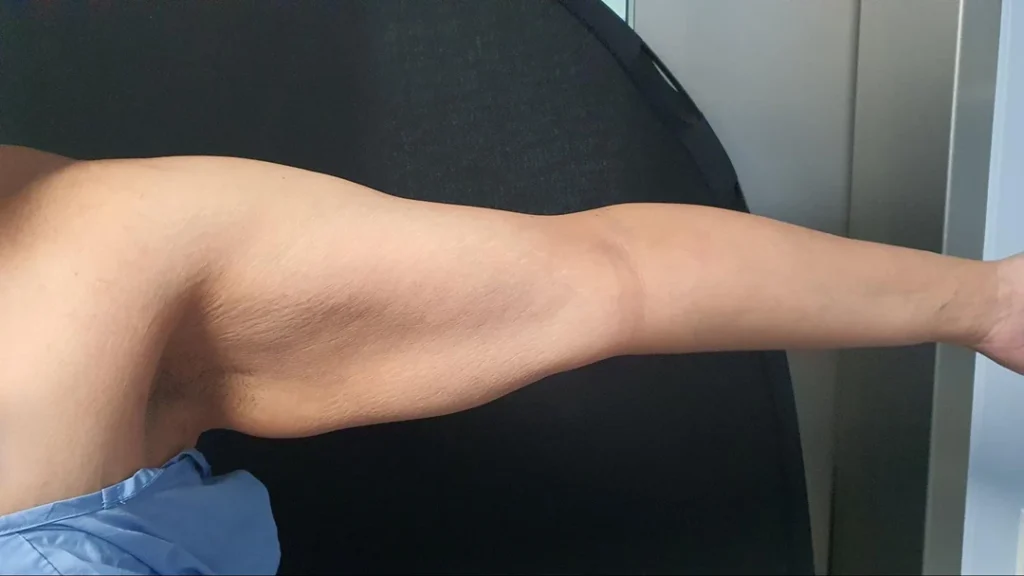 arm lift surgery after weight loss Singapore.