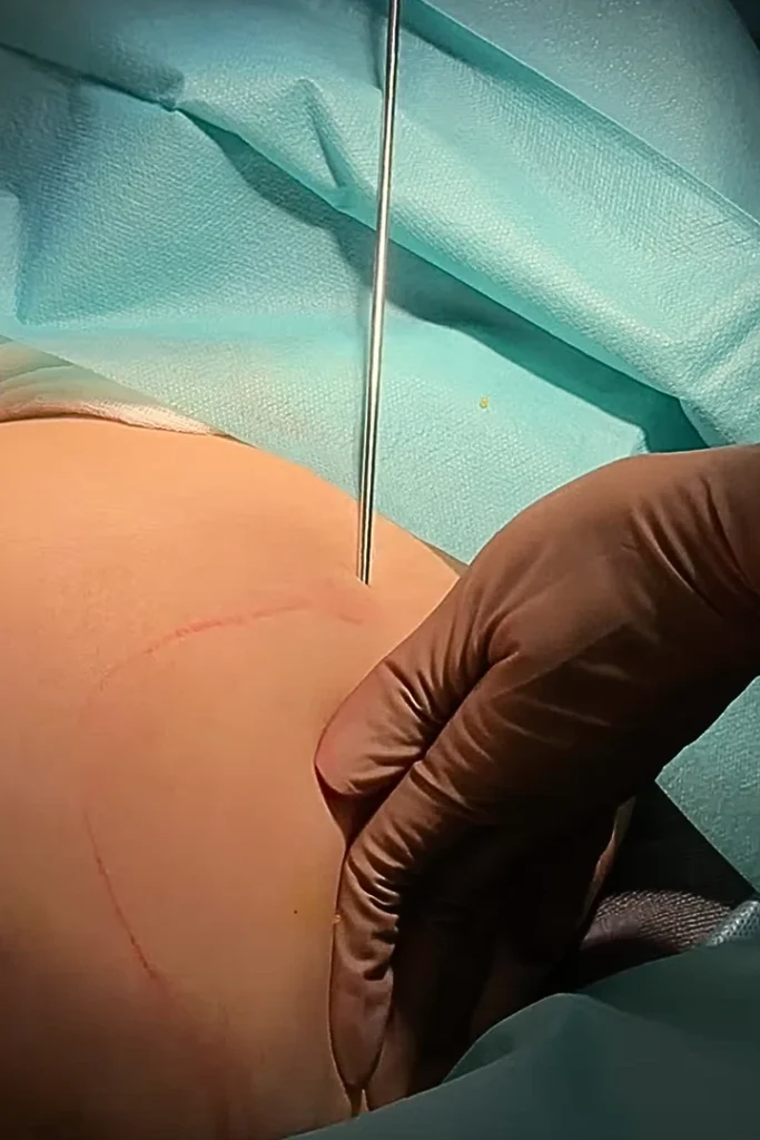Outer thigh liposuction performed as part of thigh contouring surgery at Pearl Plastic Surgery, Singapore.