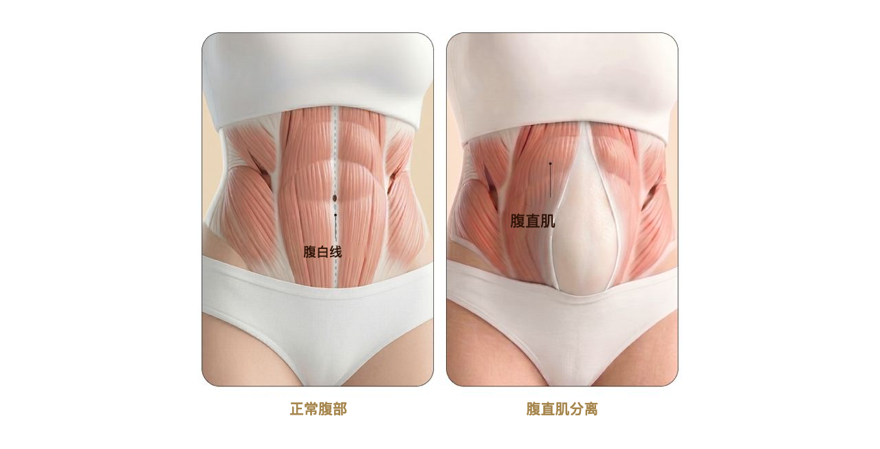 正常腹部与腹直肌分离对比
