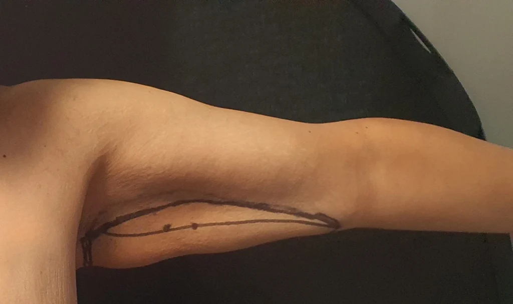 Preoperative surgical markings along the inner upper arm before brachioplasty (arm lift) surgery.