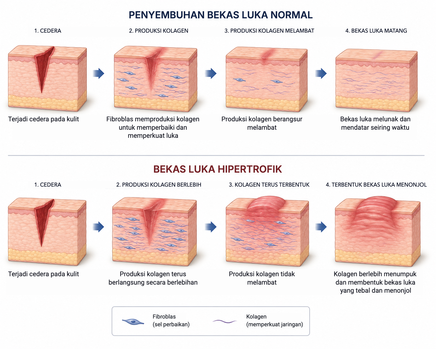 Perbandingan penyembuhan bekas luka normal dan bekas luka hipertrofik dalam empat tahap