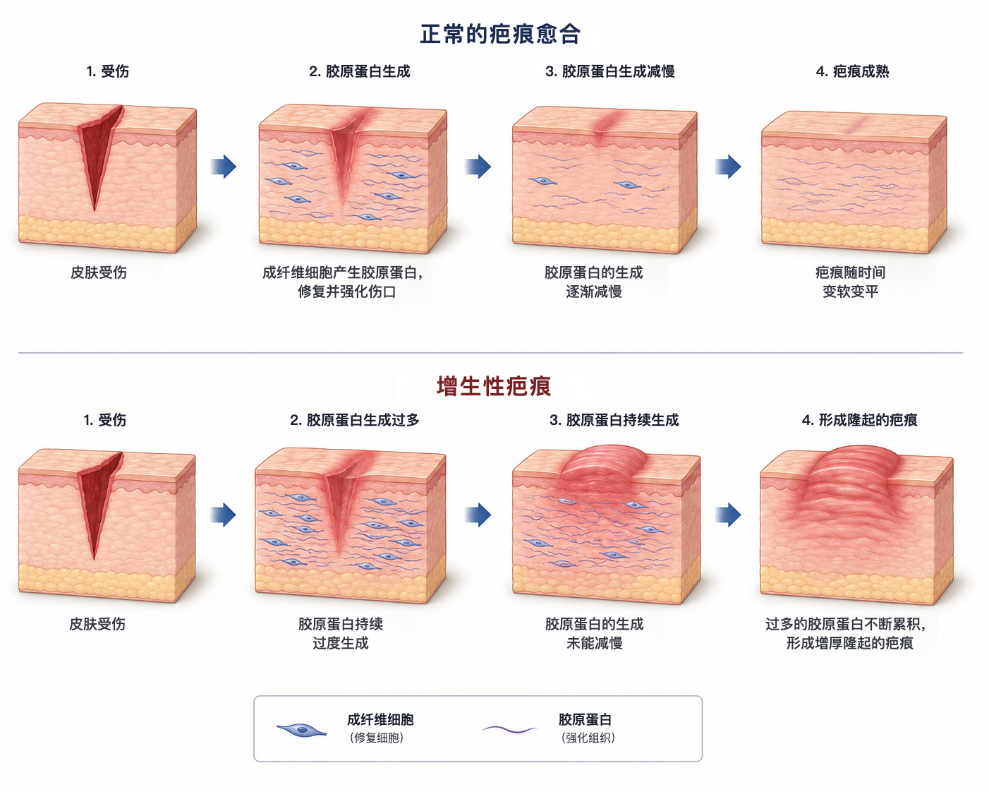 正常的疤痕愈合与增生性疤痕的形成过程