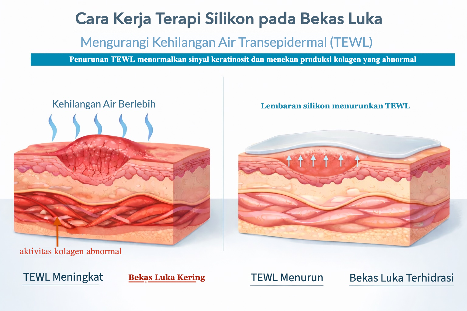 Cara kerja terapi silikon pada bekas luka: mengurangi kehilangan air transepidermal (TEWL)