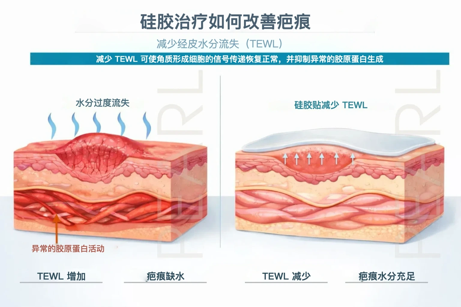 硅胶治疗如何改善疤痕：减少经皮水分流失（TEWL）