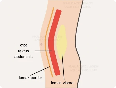 Penampang perut pria: otot rektus abdominis, lemak perifer, dan lemak viseral