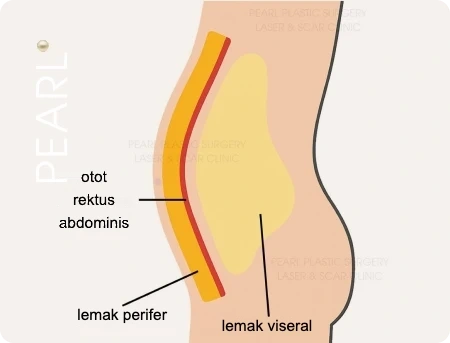 Penampang perut pria: otot rektus abdominis, lemak perifer, dan lemak viseral