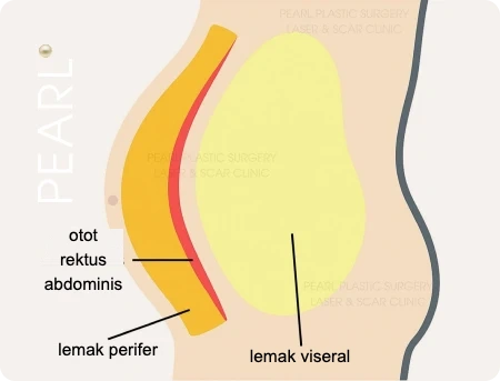 Penampang perut pria: otot rektus abdominis, lemak perifer, dan lemak viseral