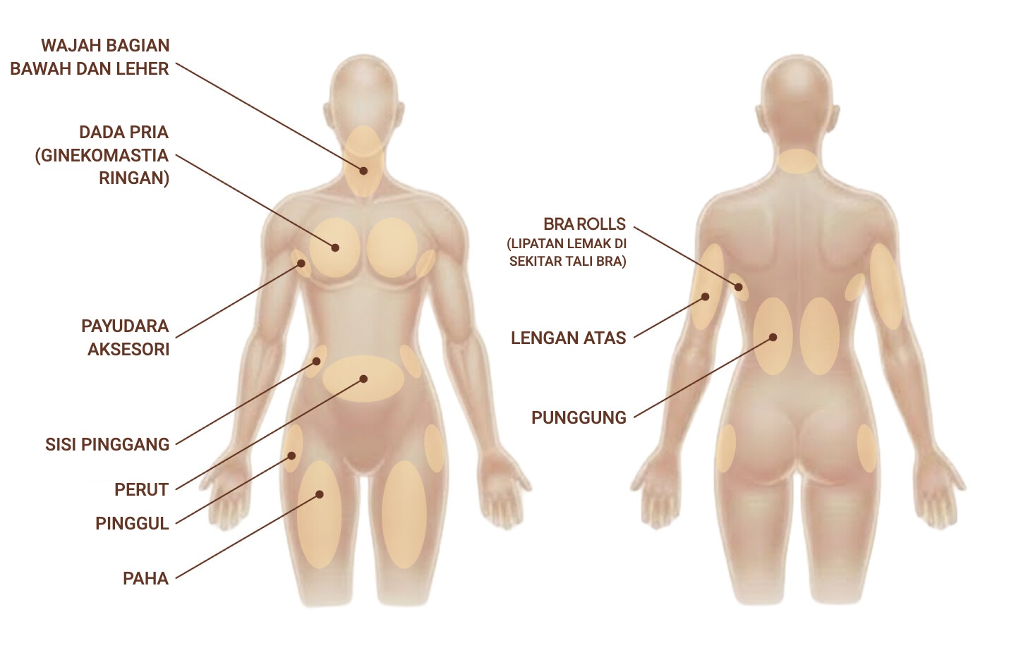 Area tubuh yang dapat dirawat dengan RFAL: wajah bagian bawah dan leher, dada pria, payudara aksesori, sisi pinggang, perut, pinggul, paha, bra rolls (lipatan lemak di sekitar tali bra), lengan atas, dan punggung