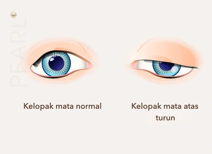 Kelopak mata normal dan kelopak mata atas turun (ptosis)