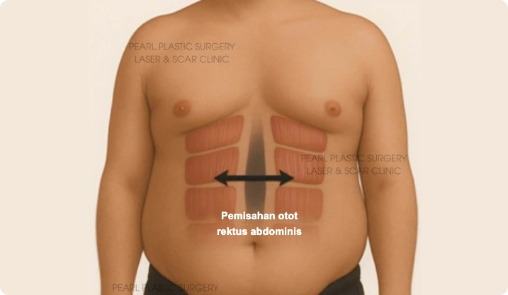 Pemisahan otot rektus abdominis pada perut pria